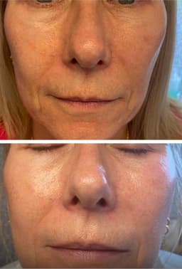 Dermaqual 24 point non surgical face-lift