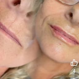 Lip filler