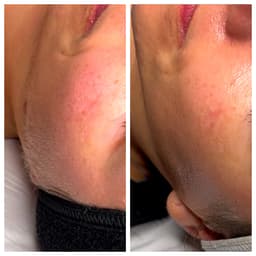 Dermaplane treatment removes vellus hair for a flawless complexion