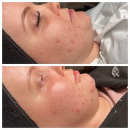 Acne bootcamp after 2 weeks, improved tone and texture of skin