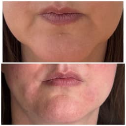 Dermal filler