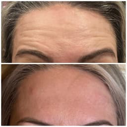 Wrinkle reduction
