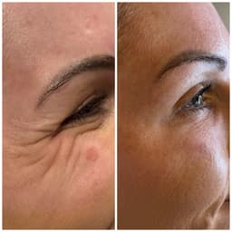 Wrinkle reduction
