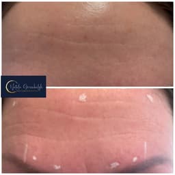 Wrinkle reducing treatment