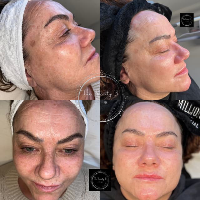 Pigmentation bootcamp results