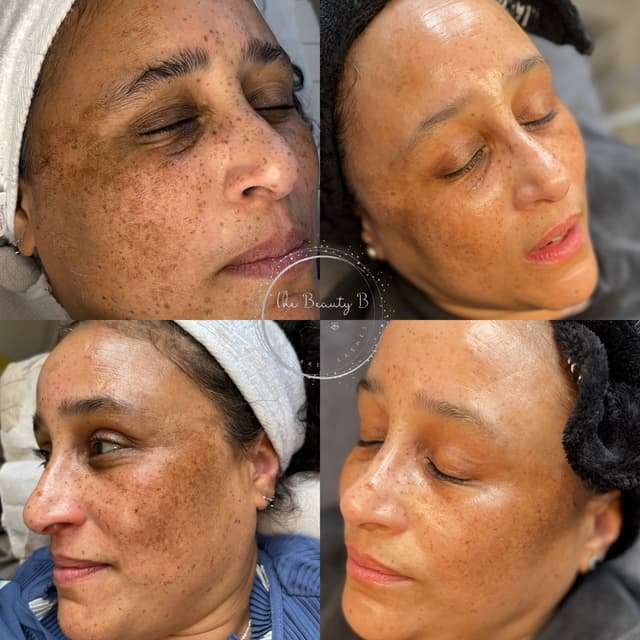 4 months difference. 1 superglow facial, 1 MDF and 3 Radiate Peels