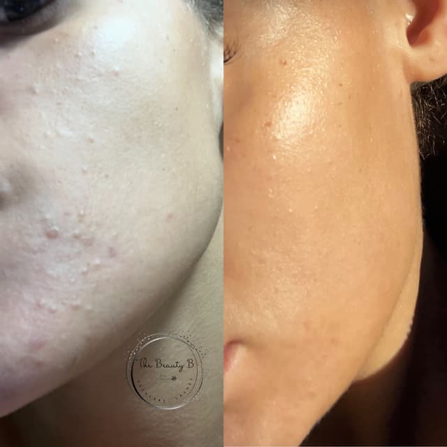 Million Dollar Immaculate Peels with steam and extracrions work best to eliminate congestion