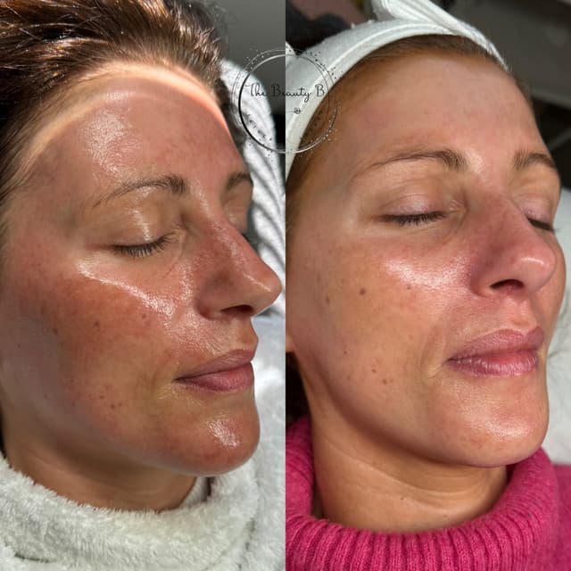 Pigmentation 3 month difference