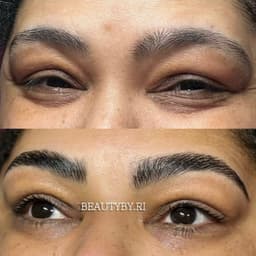 Brow Lift