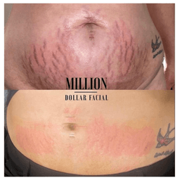 Microneedling for Stretchmarks