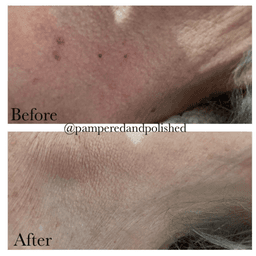 Skin Tag Removal via Cryotherapy