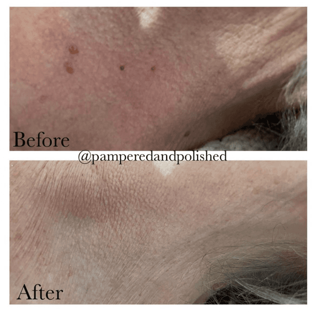 Removing skin tags with Cryotherapy