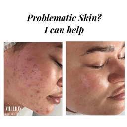 Microneedling for acne