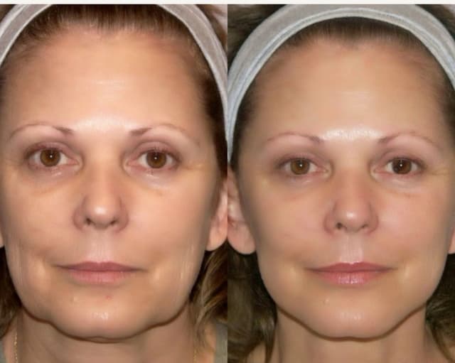 Dual Injector Pro to lift and tighten skin