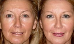 Electroporation and Radio Frequency to lift and tone the face