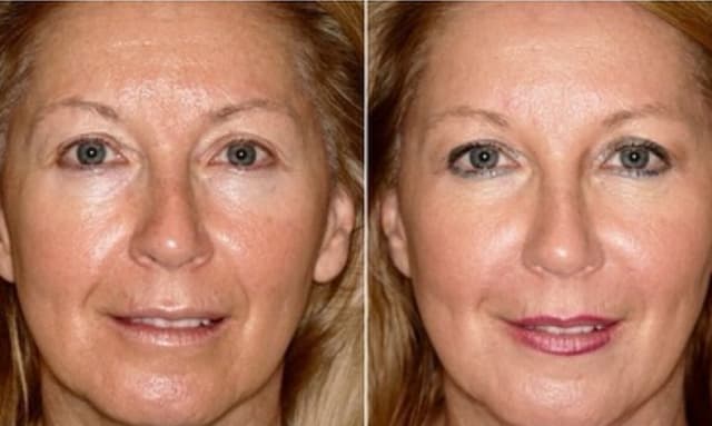 Dual Injector Pro to tighten and lift the face