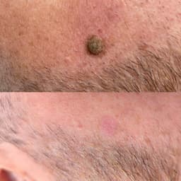 Seborrheic Keratosis removal using Cryotherapy