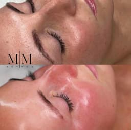 Korean Glass Skin Hydrofacial