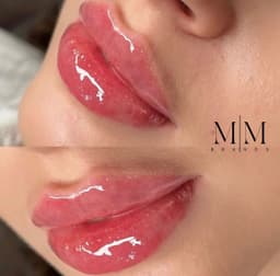 Russian Lips Augmentation