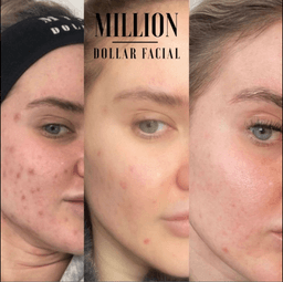 Million Dollar facial system
