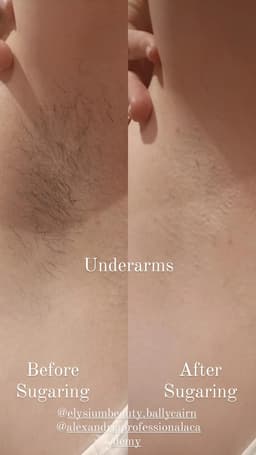 Sugaring Underarm