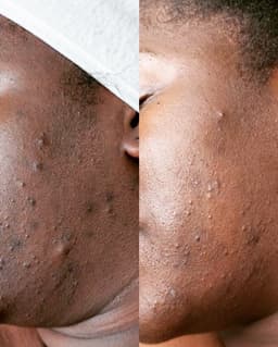 Bespoke Geneo+ & HydraFacial With BioReePeel