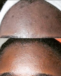 Bespoke Geneo+ & HydraFacial With BioReePeel