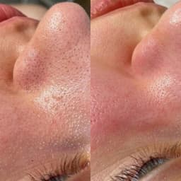 Hydrafacial