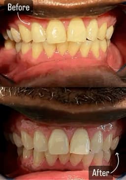 Ex smokers can also start their journey with whiter teeth