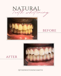 Natural teeth whitening