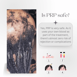 PRP platelet rich plasma