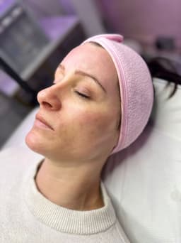 Microneedling Glow