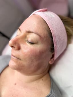 Chemical Peel Glow