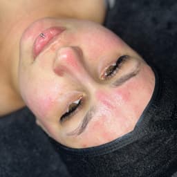 Microneedling Glow