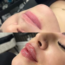 Lip filler