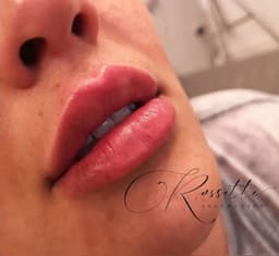 Lip Filler
