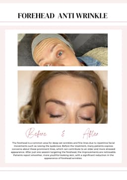 Anti wrinkle treatments