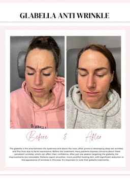 Anti wrinkle treatment