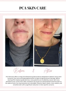 PCA medical grade skincare