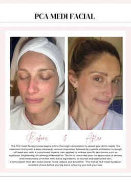 PCA Medi facial