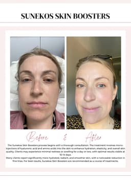 Sunekos skin booster