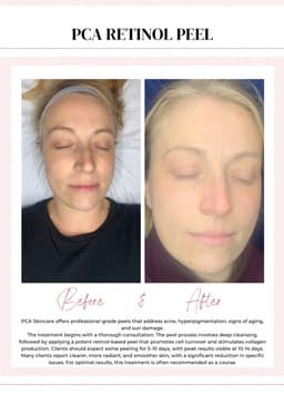 PCA prescription retinol peel