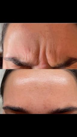 Anti wrinkle injection