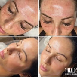 Million Dollar Facials
