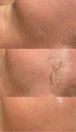 Dermaplaning