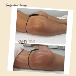 Lift, tone and sculpt with our Non-Surgical Bum Lift in Chelmsford at Kehs Beauty Studio.