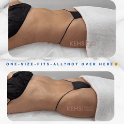 Safe, effective, and results-driven — discover non-surgical abs sculpting treatments at Kehs Beauty Studio.