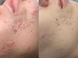 Acne scars and Acne