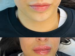 Lip Filler virgin Lips