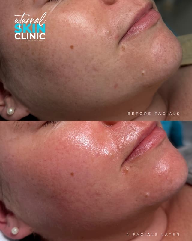 Microneedling Facial